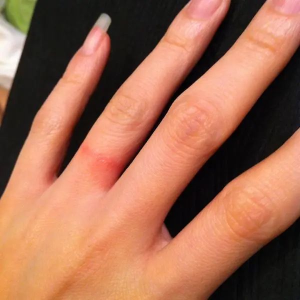 Đeo nhẫn bị dị ứng