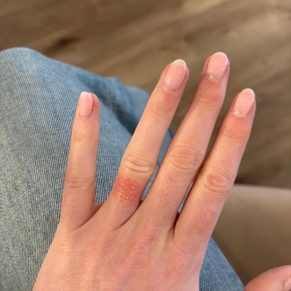 Đeo nhẫn bị dị ứng