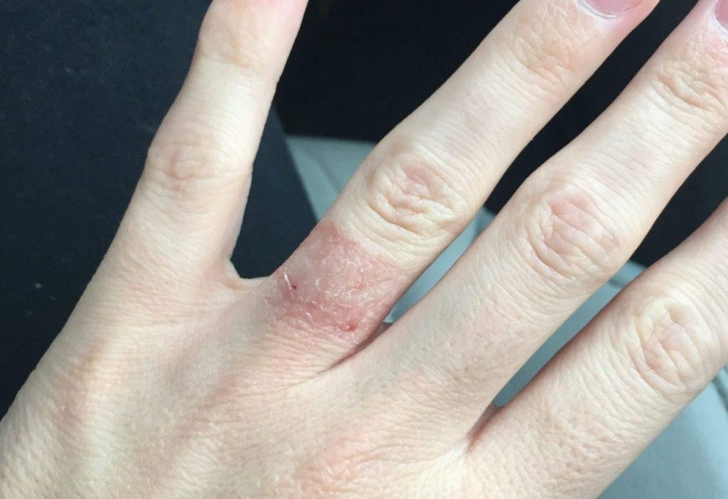 Đeo nhẫn bị dị ứng