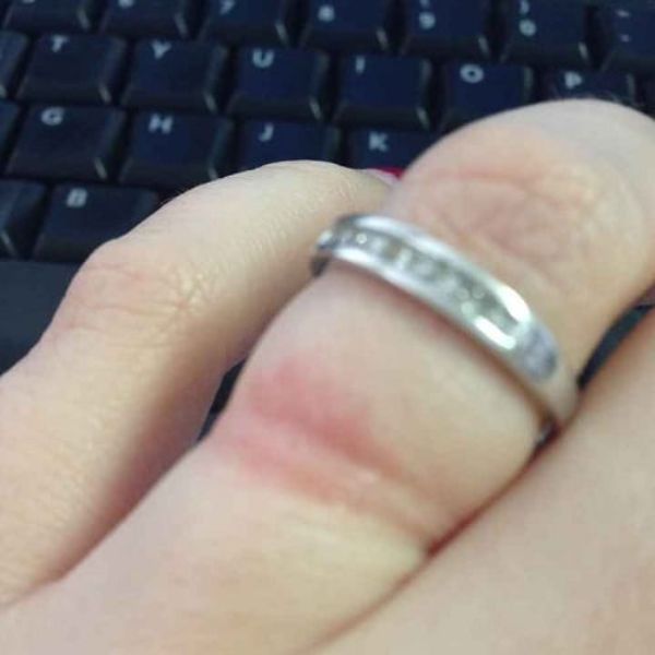 Đeo nhẫn bị dị ứng